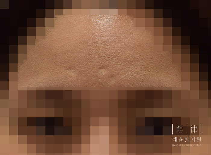 [안산점] 손톱/수두흉터/점뺀흉터 치료 전 사진 - 해율한의원