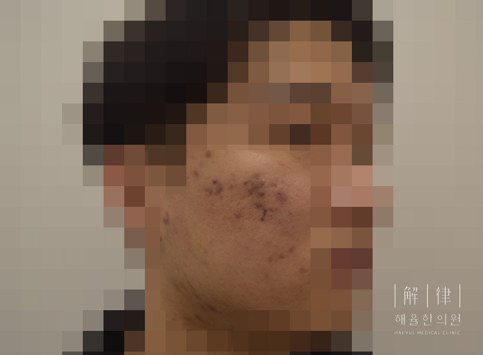 얼굴화농성여드름 치료 전 사진