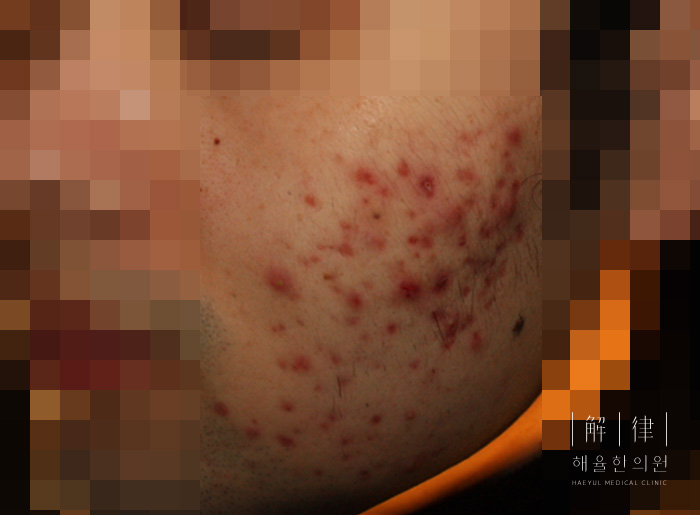 얼굴화농성여드름 치료 전 사진