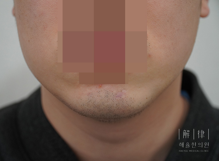[안산점] 손톱/수두흉터/점뺀흉터 치료 후 사진 - 해율한의원