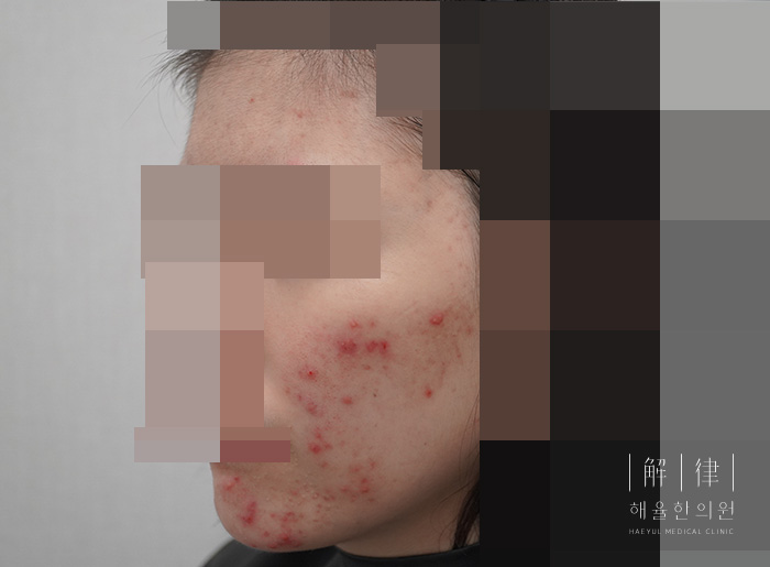 얼굴화농성여드름 치료 전 사진