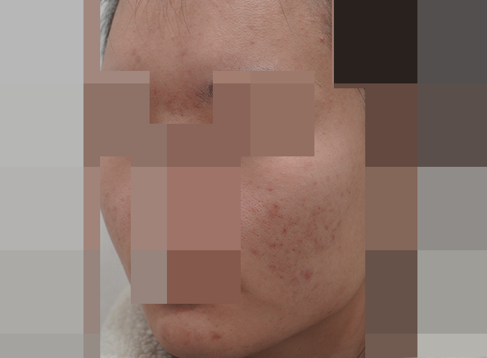 모낭염 치료 후 사진