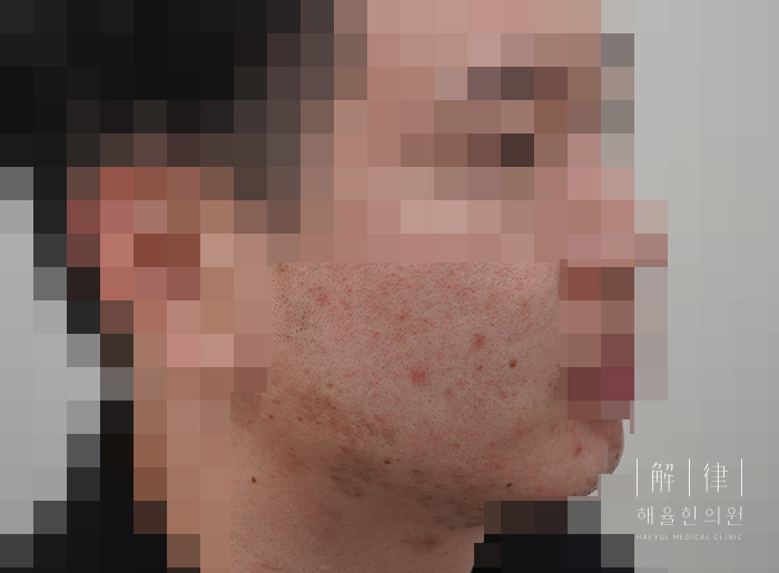 여드름자국 치료 전 사진