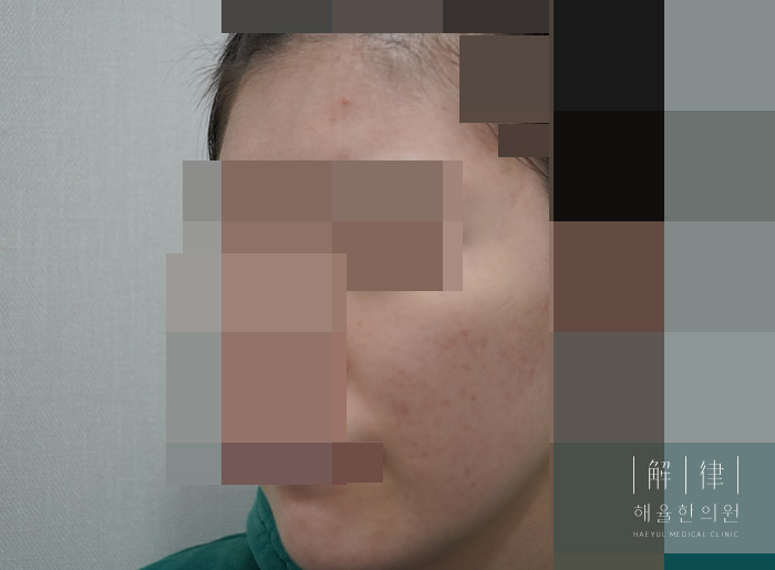 얼굴화농성여드름 치료 후 사진
