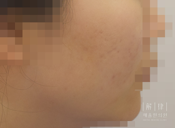 여드름자국 치료 후 사진