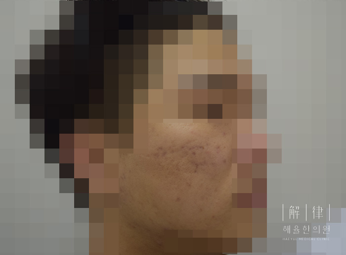 얼굴화농성여드름 치료 후 사진