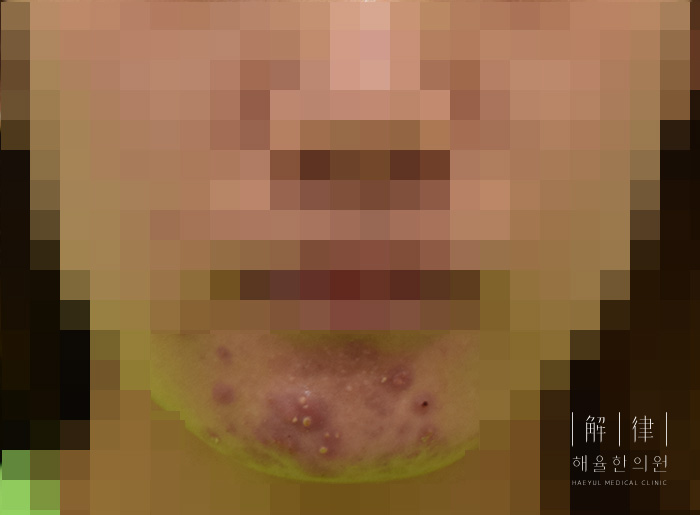 얼굴화농성여드름 치료 전 사진