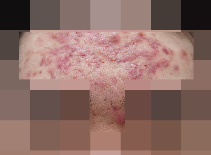 모낭염 치료 전 사진