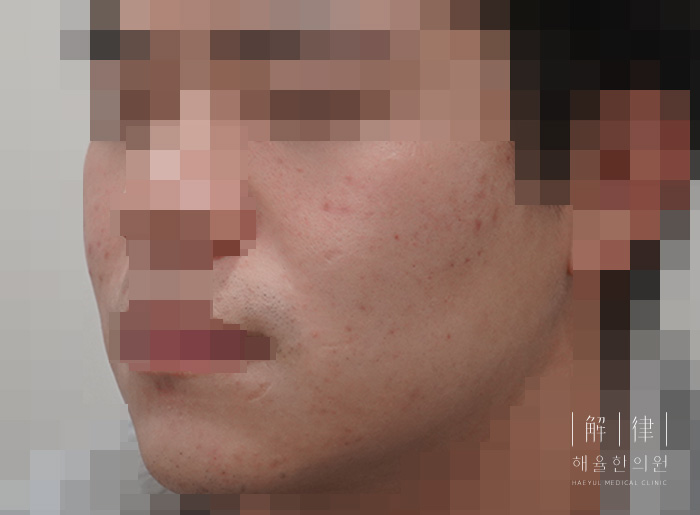 모낭염 치료 후 사진