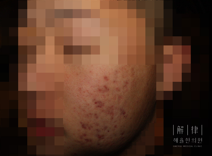 여드름자국 치료 전 사진