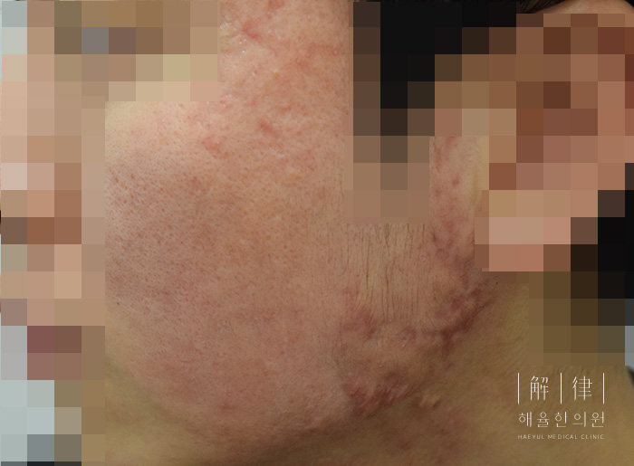 모낭염 치료 후 사진