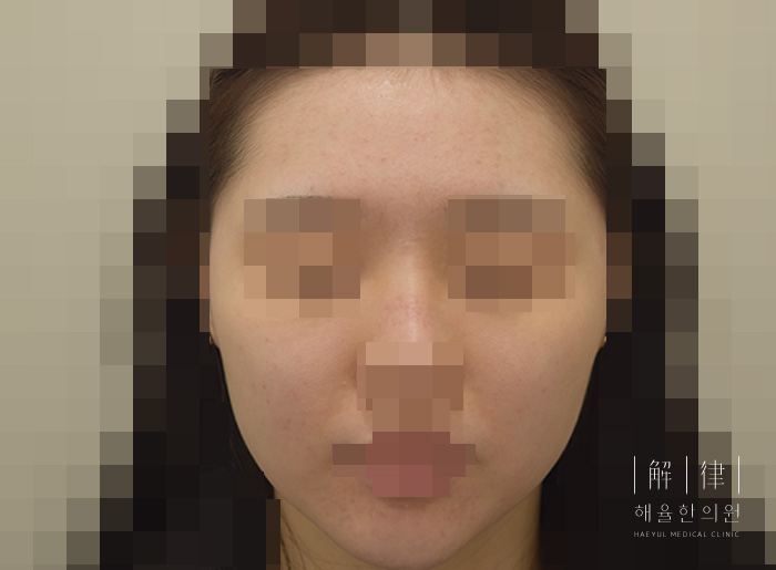 모낭염 치료 후 사진