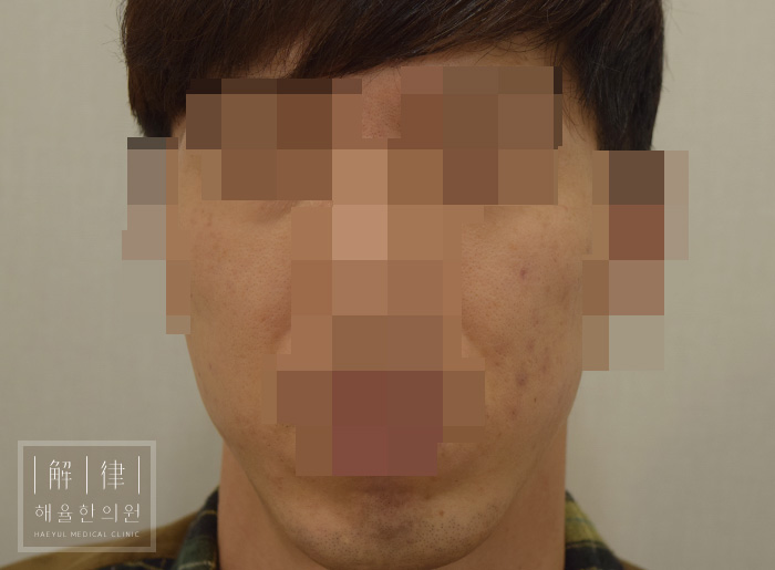 얼굴화농성여드름 치료 후 사진