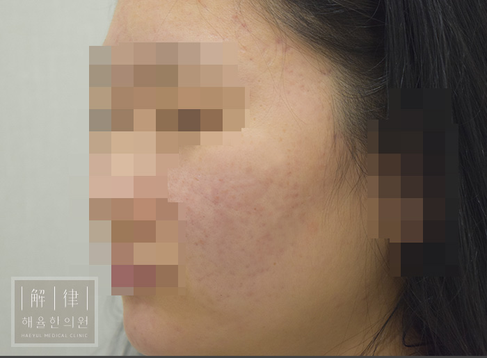 얼굴화농성여드름 치료 후 사진