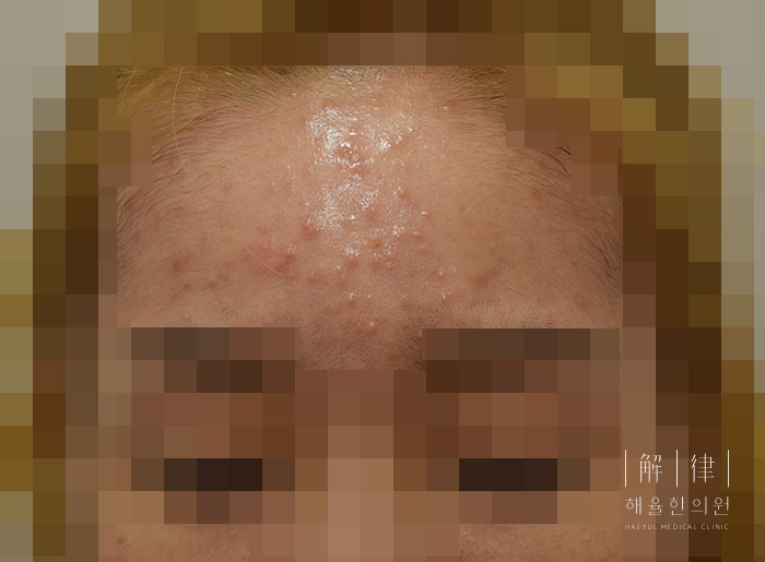 얼굴좁쌀여드름 치료 전 사진