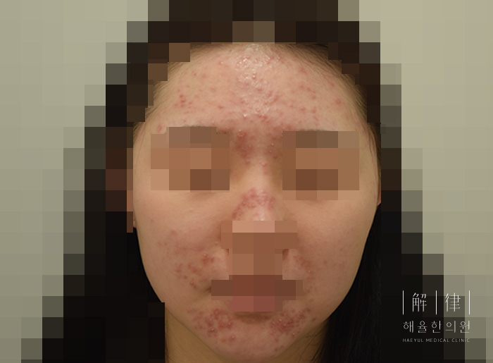 모낭염 치료 전 사진