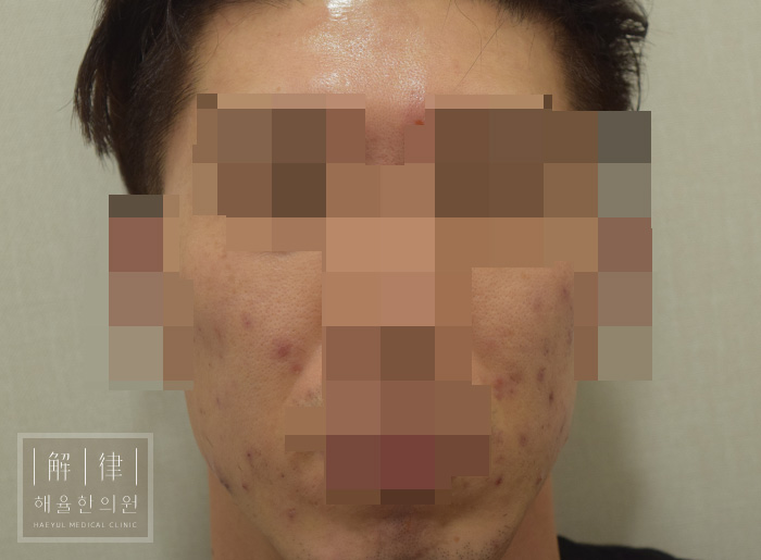 얼굴화농성여드름 치료 전 사진