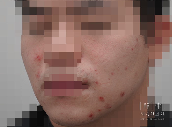 모낭염 치료 전 사진