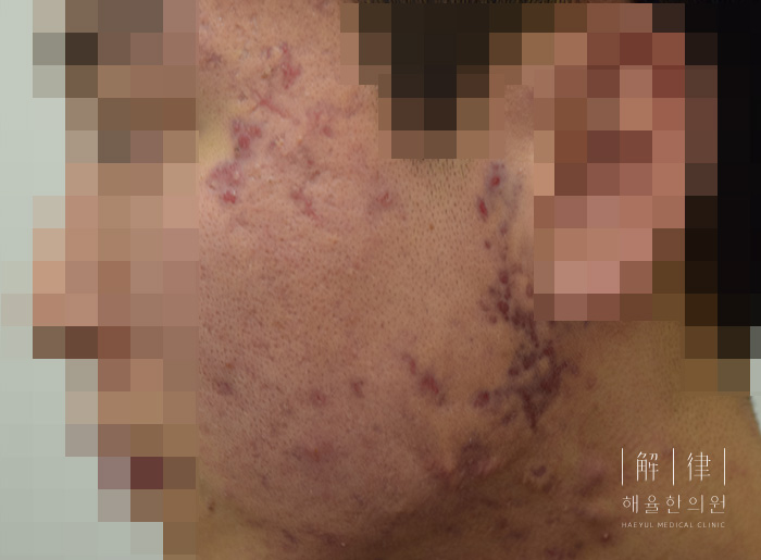 모낭염 치료 전 사진