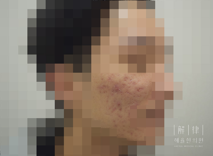 모낭염 치료 후 사진