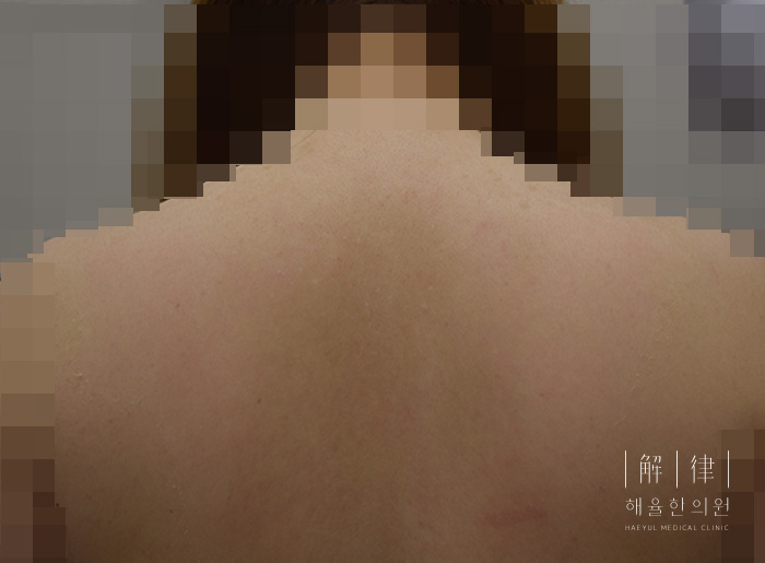 여드름자국 치료 후 사진