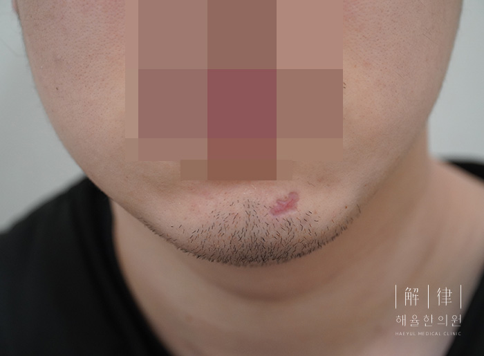 [안산점] 손톱/수두흉터/점뺀흉터 치료 전 사진 - 해율한의원