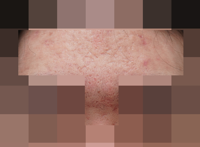 모낭염 치료 후 사진