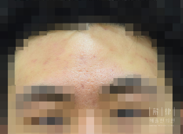얼굴화농성여드름 치료 후 사진