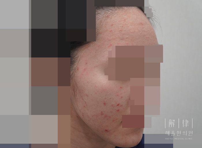 모낭염 치료 전 사진