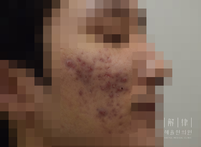 모낭염 치료 전 사진
