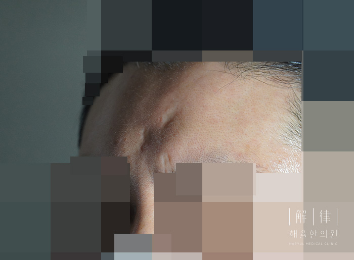 [안산점] 손톱/수두흉터/점뺀흉터 치료 전 사진 - 해율한의원