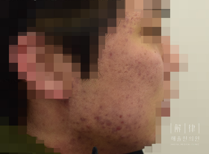 여드름자국 치료 전 사진