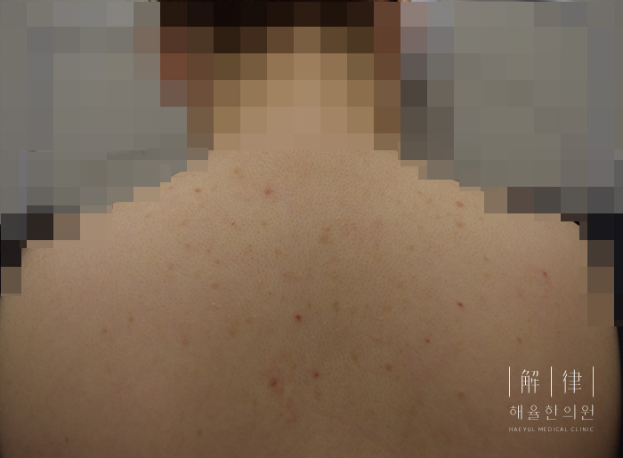 여드름자국 치료 전 사진