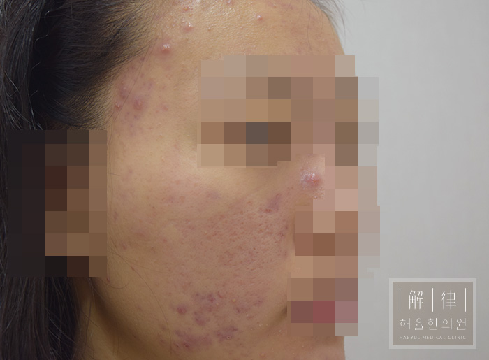 얼굴화농성여드름 치료 전 사진