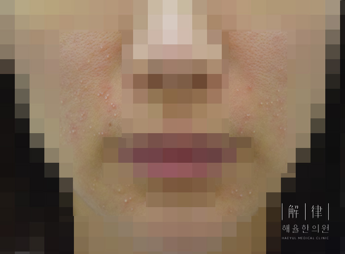 얼굴화농성여드름 치료 전 사진
