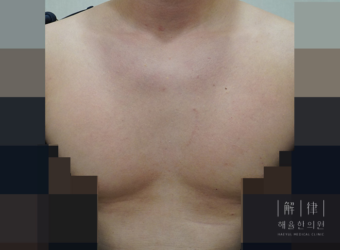 가슴여드름 치료 후 사진
