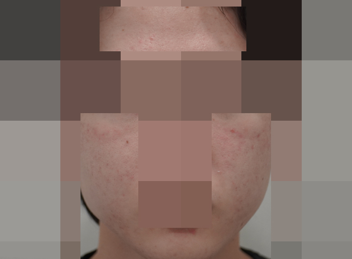 모낭염 치료 후 사진