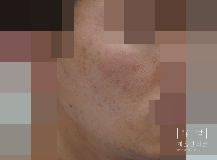 여드름자국 치료 후 사진
