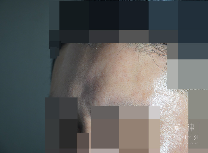 [안산점] 손톱/수두흉터/점뺀흉터 치료 후 사진 - 해율한의원