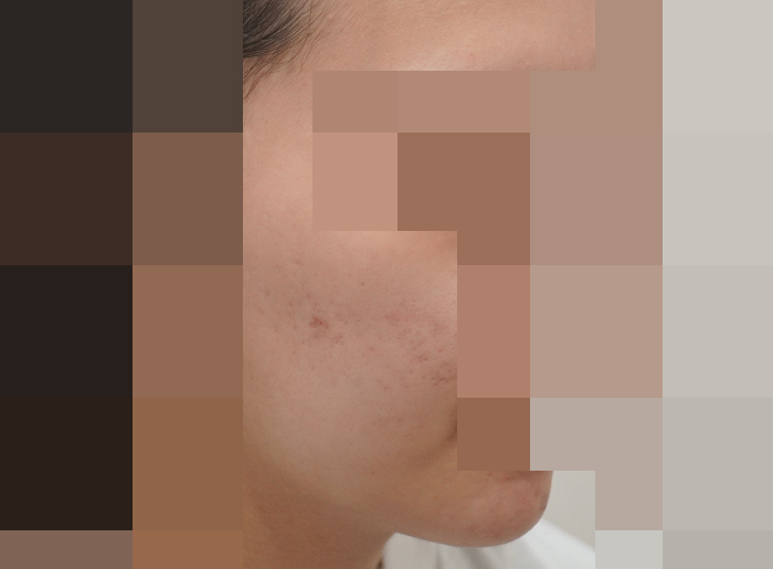 모낭염 치료 후 사진