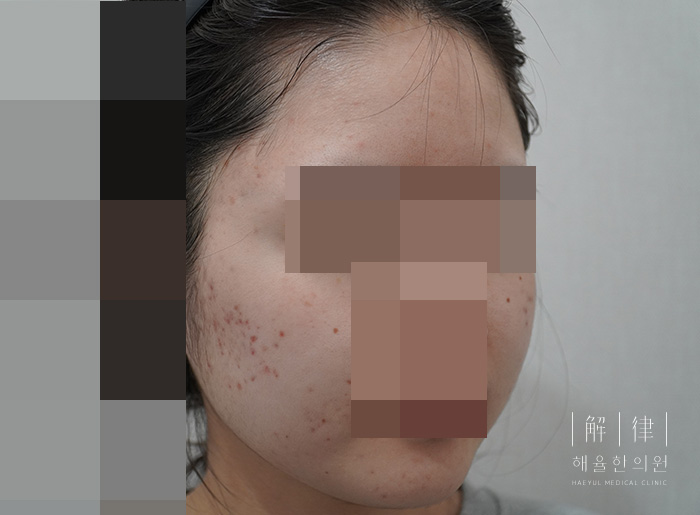 여드름자국 치료 전 사진