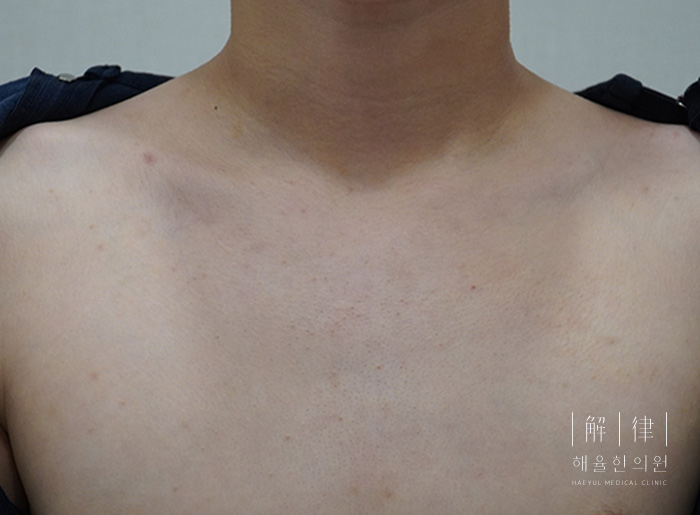 얼굴좁쌀여드름 치료 후 사진