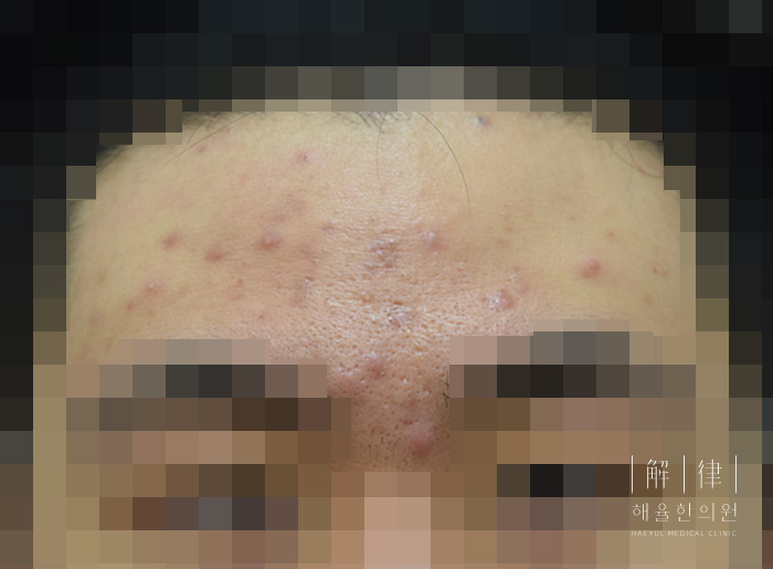 얼굴화농성여드름 치료 전 사진