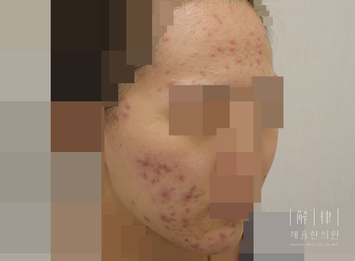 얼굴화농성여드름 치료 전 사진