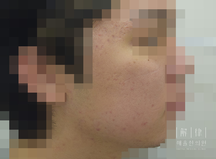 여드름자국 치료 후 사진