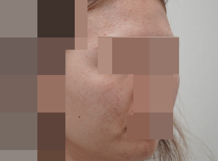 모낭염 치료 후 사진