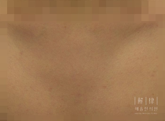 가슴여드름 치료 후 사진