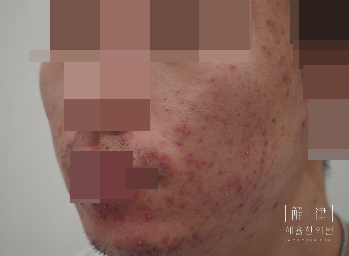 모낭염 치료 전 사진