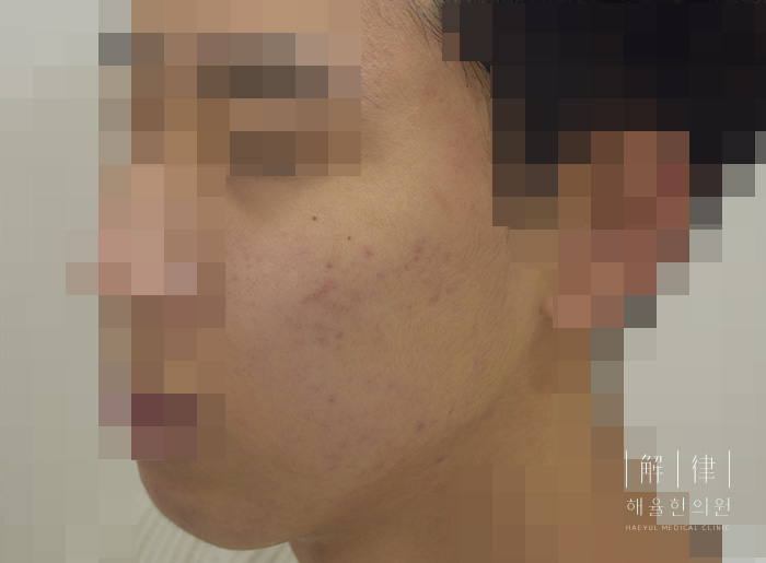 모낭염 치료 후 사진
