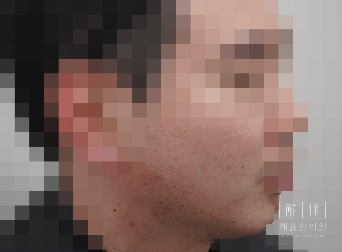 여드름자국 치료 후 사진